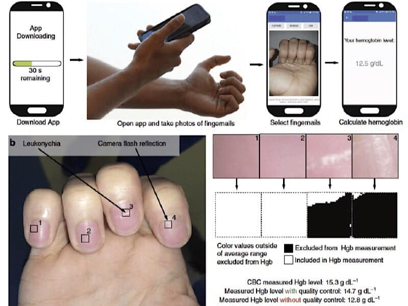 صورة لـ تطبيق جديد للهاتف الذكي سيكشف فقر الدم من خلال أظافرك فقط | news-anemia-fingernails-diagram-DzTechs